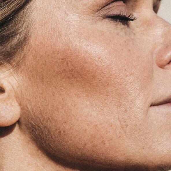 Pigmentation spots 