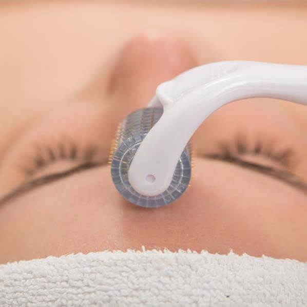 Microneedling – alles, was Sie über die innovative Behandlungsmethode wissen müssen